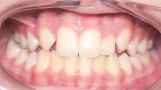 Canine Substitution Missing Lateral Incisor Kyger Orthodontics [upl. by Byron]