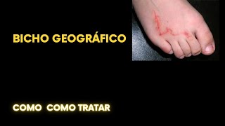 Bicho geográfico como tratar [upl. by Erdman]