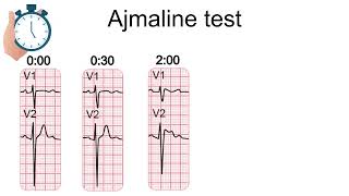 Ajmaline test amp Brugada syndrome [upl. by Ermentrude]