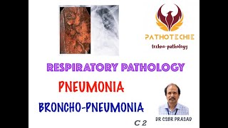 Pneumonia  Bronchopneumonia [upl. by Melisent]