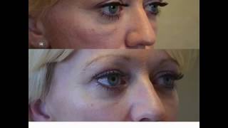 Dissolving Under Eye Fillers  Kami Parsa MD in Beverly Hills CA [upl. by Eniamreg121]