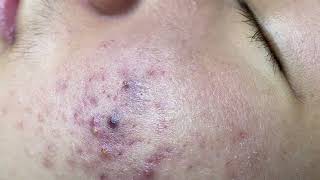 Acne treatment for Spa Linh Mun 2023 099 [upl. by Essilem]