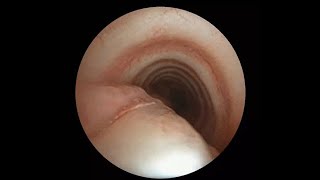 INTUBATION INJURIES  TRACHEAL LACERATION [upl. by Derayne]