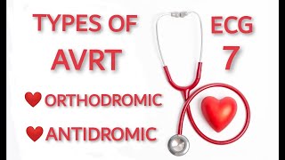 AVRT TYPES ORTHODROMIC AND ANTIDROMIC [upl. by Soutor407]