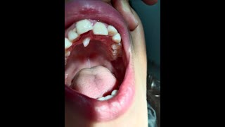 supernumerary teeth treatment  extra teeth treatment subscribe like 🦷 [upl. by Bully]