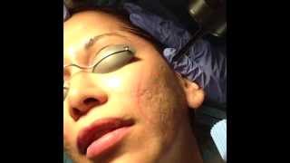 Acne Scarring Treated with Mixto CO2 laser Dr David Rahimi Forever Young Inc [upl. by Shelia]