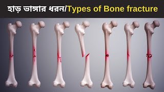 Common types of Bone fracture  3D animation  Bangla [upl. by Aniloj]