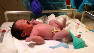 Baby 3 Live Birth in 4K UHD Video Csection Operation Delivery camera recording [upl. by Oiralednac465]