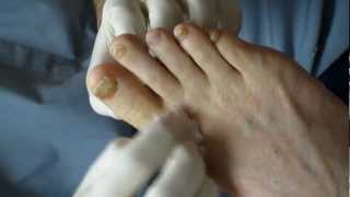 Total Nail Avulsion Timonium Foot and Ankle Center Part 1 [upl. by Malonis447]