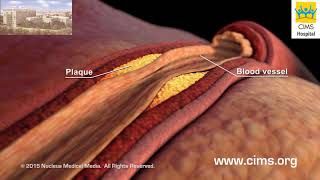 Hyperlipidemia High Cholesterol Hindi  CIMS Hospital [upl. by Ardnalak]