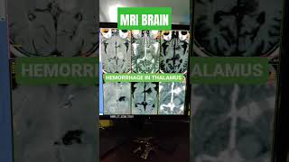 Brain Hemorrhage MRI shorts youtubeshorts shortsfeed [upl. by Thomasa37]