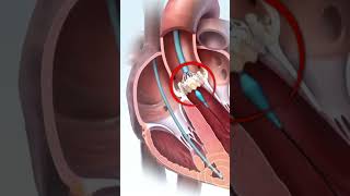 हार्ट के वाल्व को कैसे ठीक करते है  How to Fix a Heart Valve with TAVI Surgery in Animation [upl. by Loren]