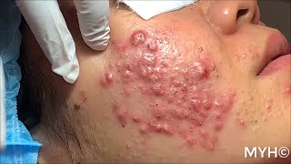 Cystic Pustules Acne Extractions EP14 No Clickbait [upl. by Nylasoj324]