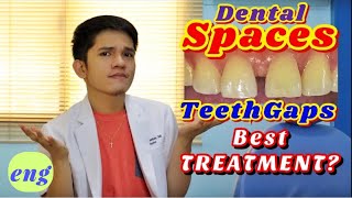 DENTAL SPACES AND GAPS TreatmentsREVEALED and EXPLAINED [upl. by Acilejna20]