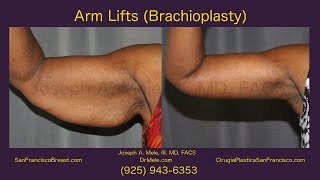 Arm Lift Brachioplasty San Francisco Bay Area [upl. by Anhaj]