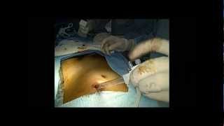 e TEP repair of a direct and a femoral hernia [upl. by Meuser613]