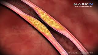 STENT INIMA  DR PRETORIAN  REGINA MARIA PONDERAS ACADEMIC HOSPITAL  TEL 021 9886 [upl. by Bradley854]