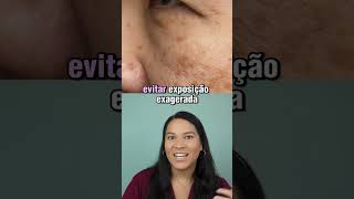 Proteção solar é essencial para quem tem melasma estética melasma [upl. by Farah]