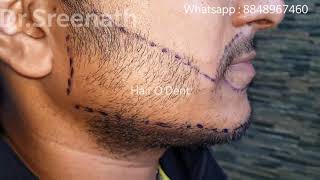 Beard Transplant in Kerala  8 months results  Without Minoxidil  DrSreenath  Hair O Dent Kochi [upl. by Jemmie]