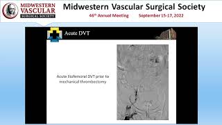 Initial Outcomes in Iliofemoral Stenting in Acute vs Chronic DVT [upl. by Mahgirb]