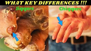 Chiggers vs Jiggers 9 Key Differences Biting Fleas amp Mites [upl. by Atilrahc]