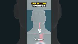 Tracheotomy doctor airway throatcancer throatinfection breathing explore medicovlogs [upl. by Einyaj]