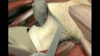 3D Medical Animation MicroHip Total Hip Joint Replacement Surgery THR by Dr Markus C Michel [upl. by Ogu728]