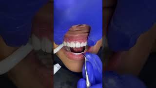 Breaking away temporary smile on revision case dentist dentistry veneers [upl. by Illene]