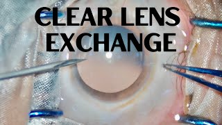 Clear Lens Extraction  Refractive Surgery in Hypermetropia [upl. by Schapira511]