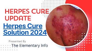 Herpes Cure Solution 2024 [upl. by Meredeth]