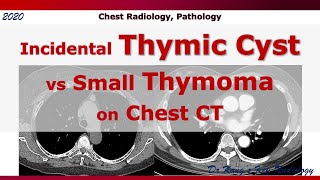 Incidental Thymic Cyst vs Small Thymoma CT [upl. by Anileh]