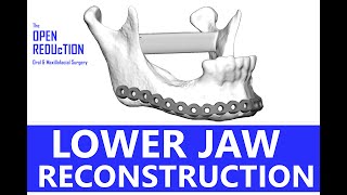 LOWER JAW RECONSTRUCTION [upl. by Hachman]