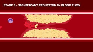 Coronary Artery Disease Animation [upl. by Aillicec]