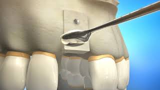 Bone Grafting Procedure Video Animation  Durham Dental Solutions [upl. by Hgeilyak]