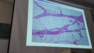 pathology practical hematoma [upl. by Salamone]