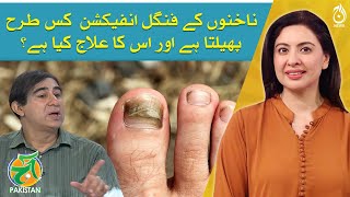 Nail Fungal Infection Causes Symptoms and Treatments  Dr Kashif Ahmed  Aaj Pakistan [upl. by Arbua]