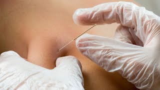 IMS Trigger Point Dry Needling Tutorial [upl. by Orat]