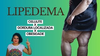 Como diferenciar Lipedema de gordura localizada celulite e obesidade sintomas [upl. by Annovaj]