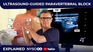 ULTRASOUNDGUIDED PARAVERTEBRAL BLOCK [upl. by Annaiuq]