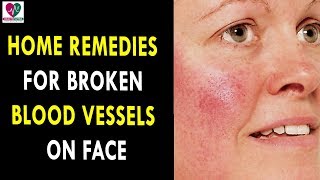 Home Remedies for Broken Blood Vessels on Face  Health Sutra  Best Health Tips [upl. by Nylaroc]