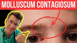 Doctor explains Molloscum Contagiosum viral skin infection  Causes symptoms and treatment [upl. by Levania]