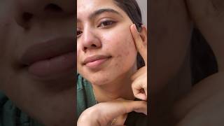 Acne treatment dry skin and peeling skincareforacneproneskin ytshortsindia [upl. by Sirrad]