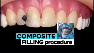 Tooth filling procedure  tooth filling cavity  dental filling procedure dentist ndc [upl. by Hayikaz]