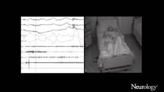 Immunotherapy of oneiric stupor in Morvan syndrome Efficacy documented by actigraphy [upl. by Otrepur256]