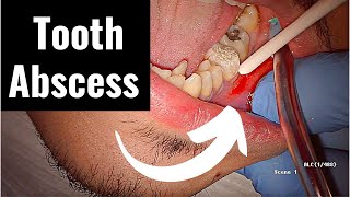 Incision and Drainage of Tooth Abscess Draining Pus [upl. by Etnoed]