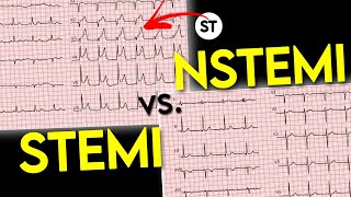 ECG interpretation  STEMI vs NSTEMI  ECG of Myocardial Infraction • Daily Cardiology [upl. by Annawt]