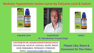 Nodular hypoechoic lesion cures by Calcaria carb amp Iodum [upl. by Zwick]