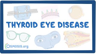 Thyroid Eye Disease causes symptoms diagnosis treatment pathology [upl. by Cailly]