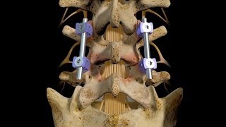 L45 Posterior Interbody Fusion [upl. by Jeffry]