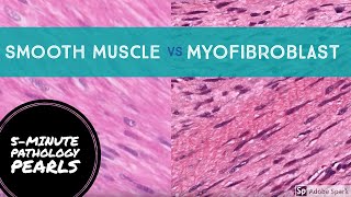 Myofibroblasts vs Smooth Muscle Made Easy 5Minute Pathology Pearls [upl. by Sherar]